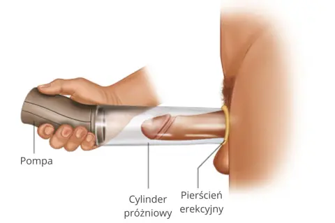 Pompka erekcyjna apteka: ilustracja pokazuje użycie cylindra próżniowego i pierścienia erekcyjnego do wspomagania erekcji.