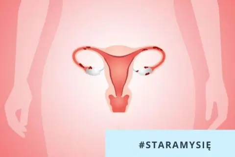 Ilustracja przedstawia tyłozgięcie macicy, które może wpływać na starania o dziecko.