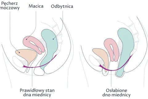 Ilustracja pokazuje różnicę między prawidłowym a osłabionym dnem miednicy. Ćwiczenia Kegla to naturalne sposoby na zwężenie pochwy i wzmocnienie mięśni.