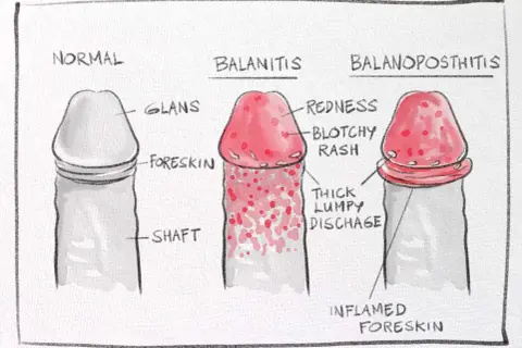 Ilustracja porównuje normalnego penisa z balanitis i balanoposthitis, pokazując objawy takie jak zaczerwienienie i wydzielina. Zrozumienie, smegma co to, jest kluczowe dla higieny.