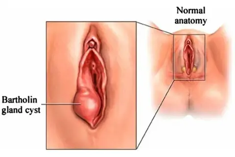 Ilustracja pokazuje ropień gruczołu Bartholina, powiększoną torbiel po lewej stronie, w porównaniu do normalnej anatomii po prawej.